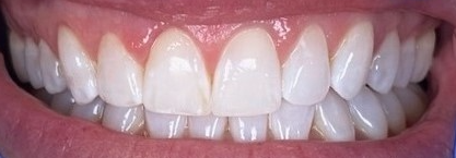 After gingivectomy