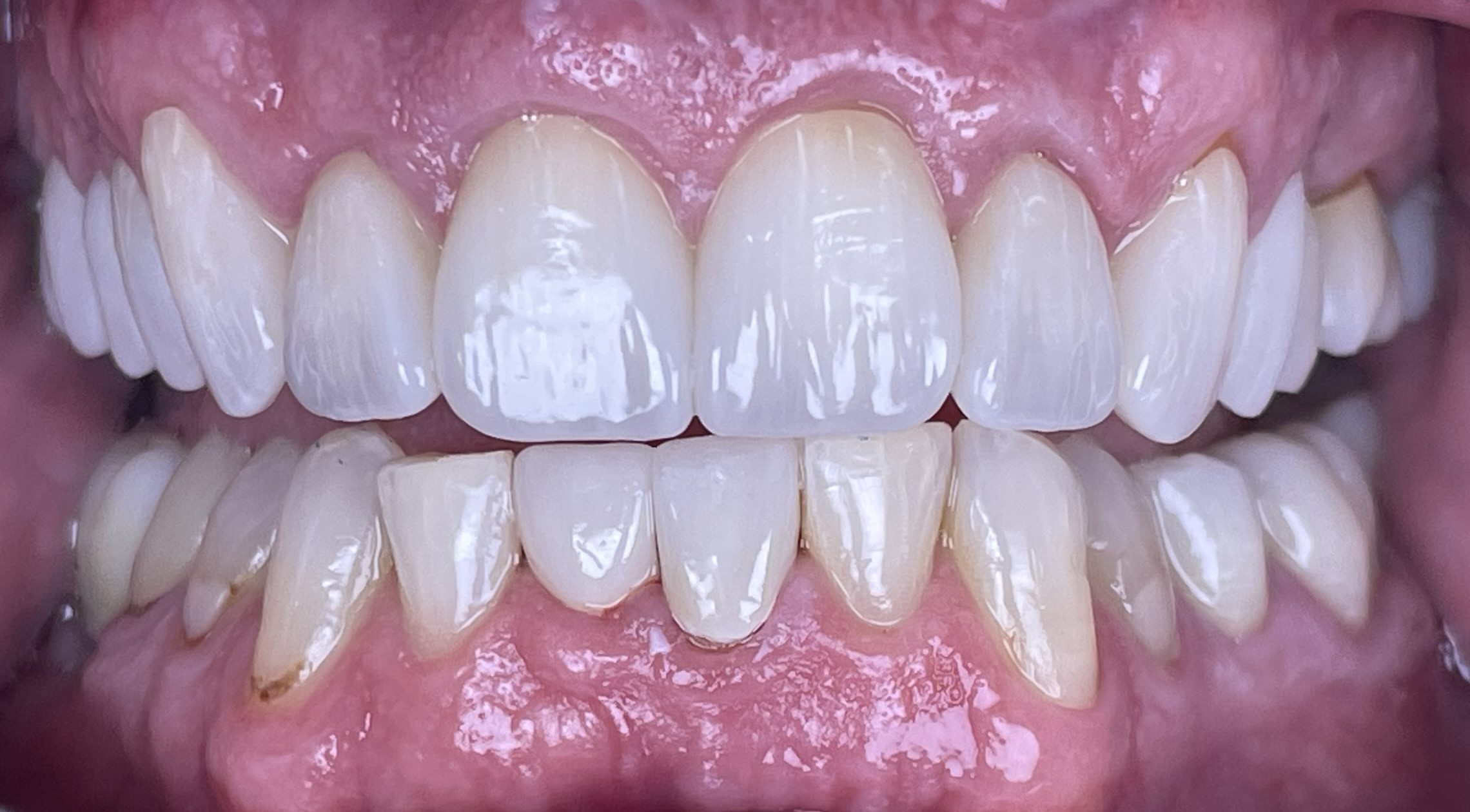 After crowns treatment