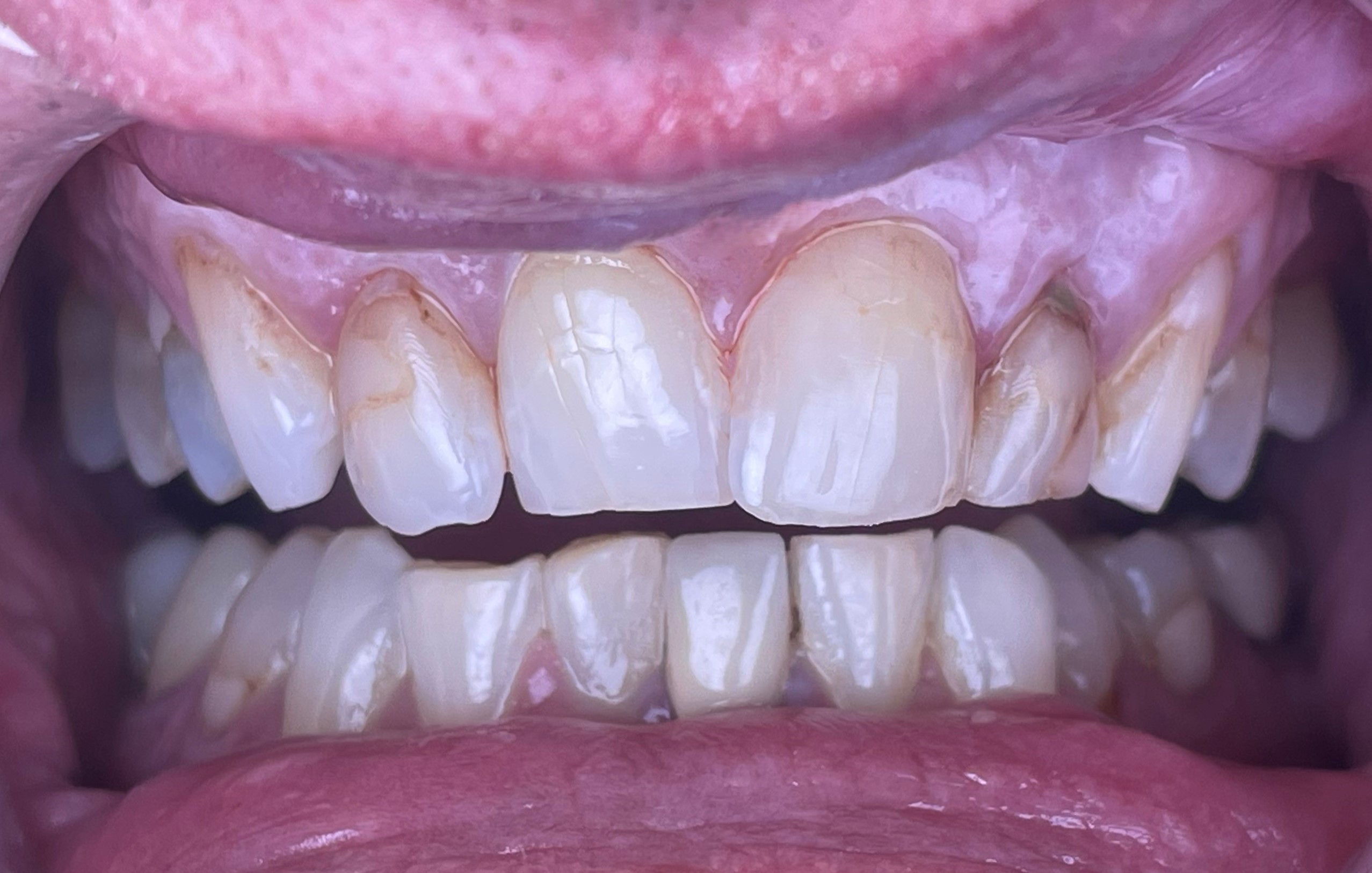 Before crowns treatment