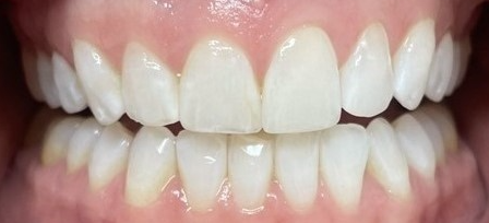 Before gingivectomy