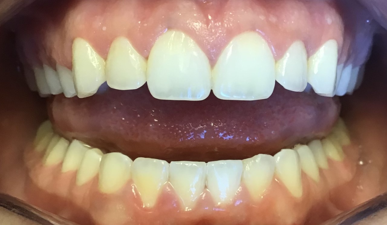 After gingivectomy