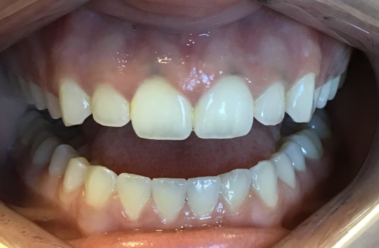 Before gingivectomy
