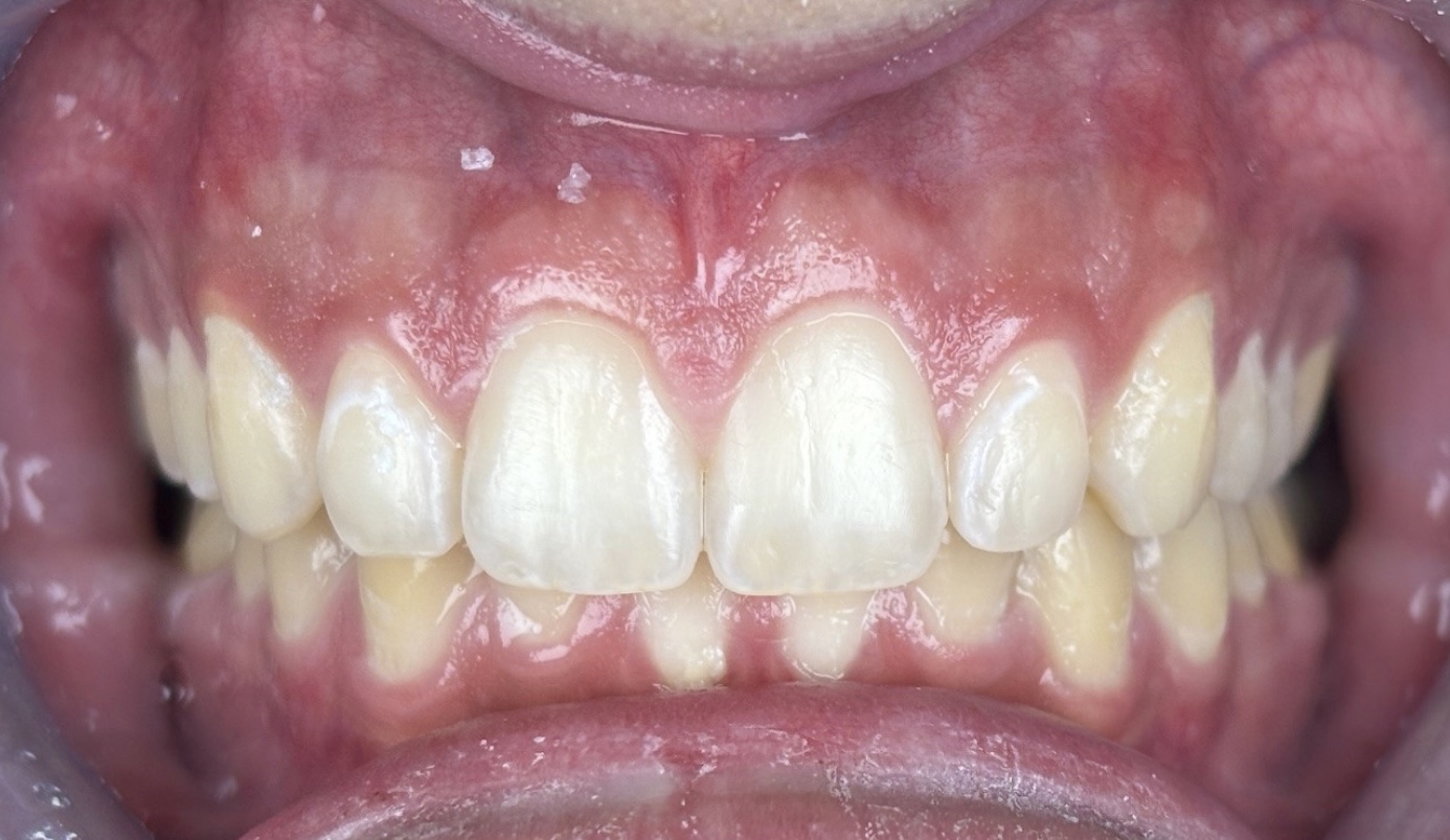 After Invisalign