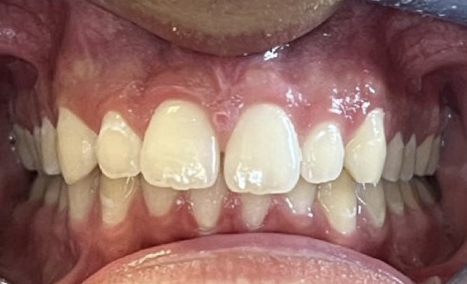 Before Invisalign