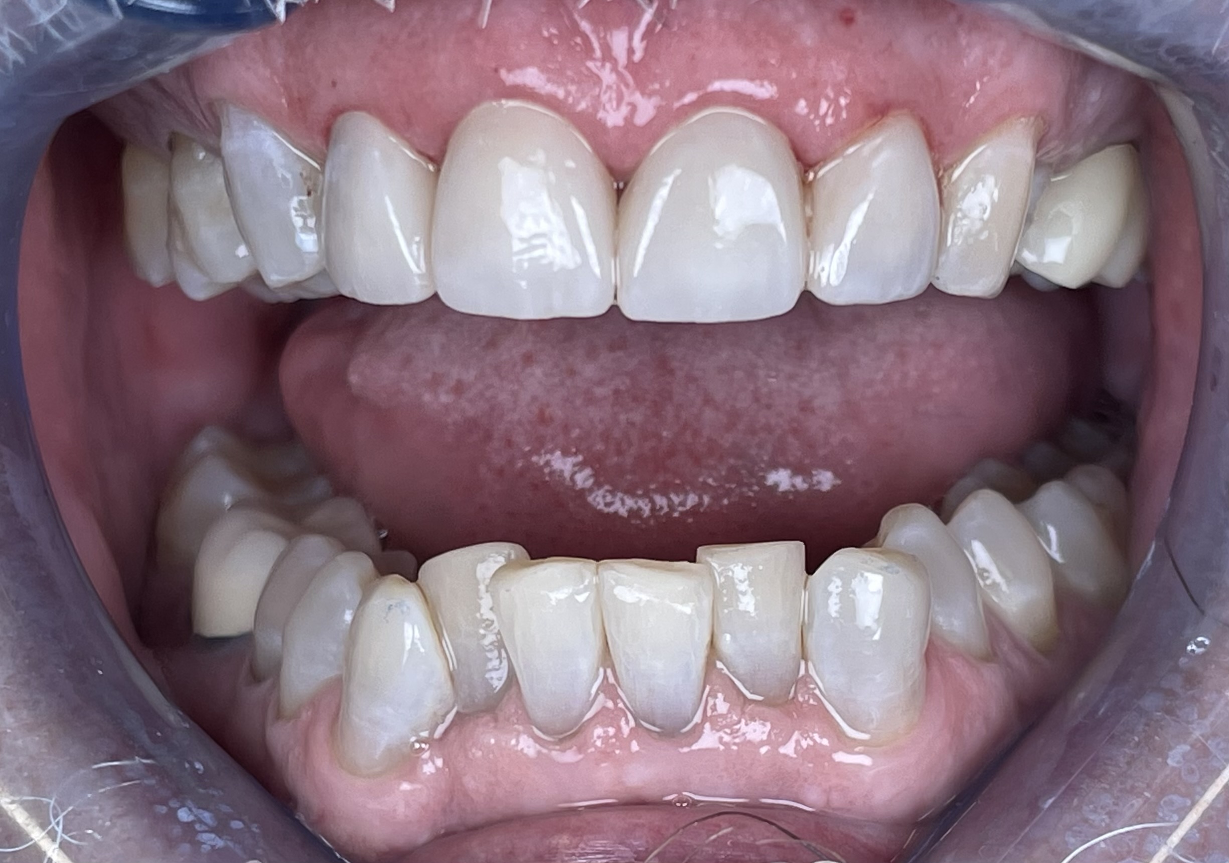 After crowns treatment