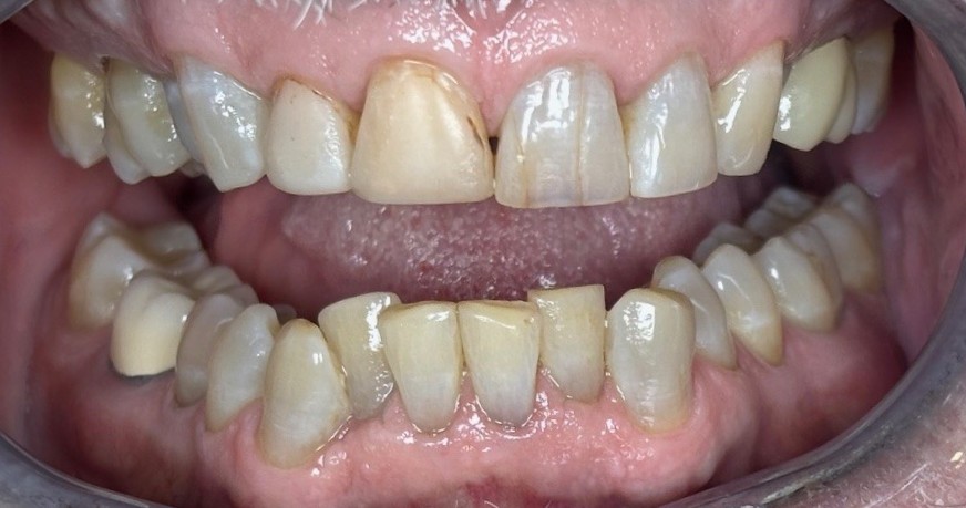 Before crowns treatment