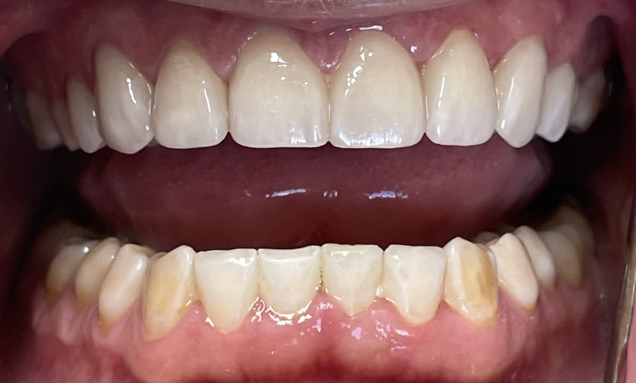 After crowns treatment