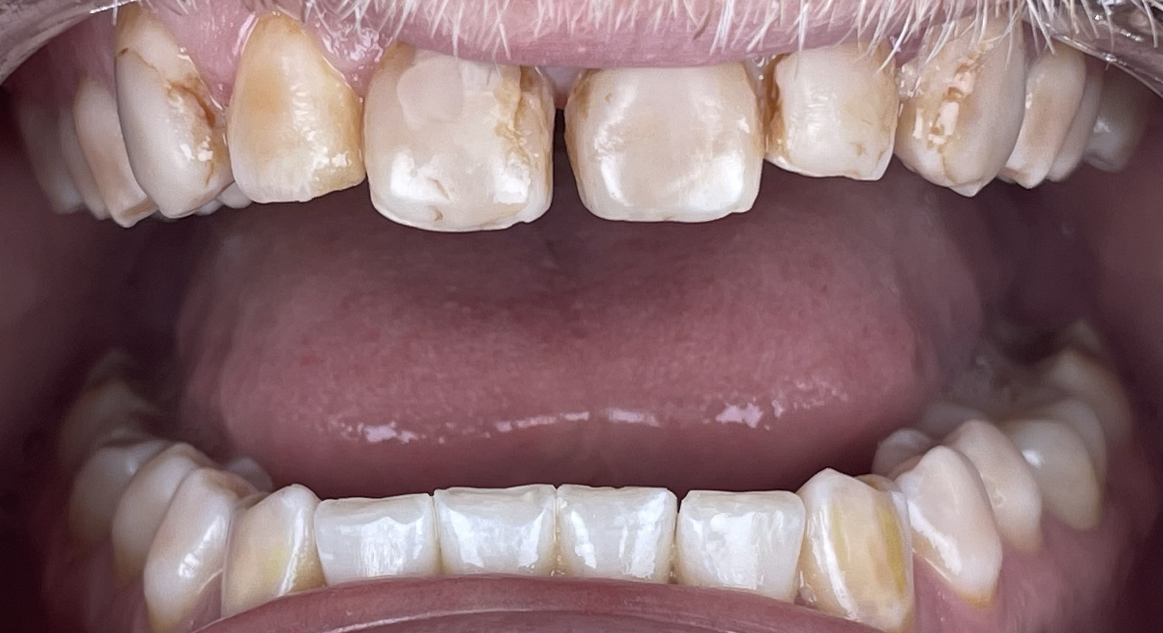 Before crowns treatment