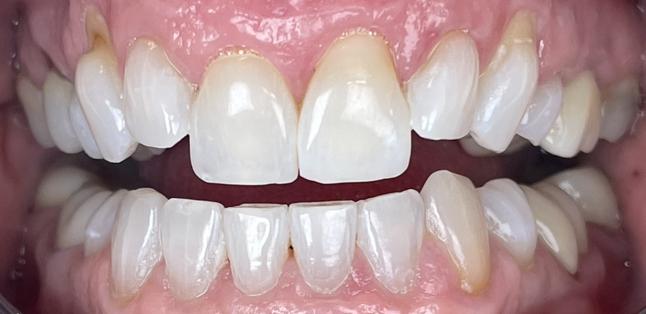 AfterZoom Whitening