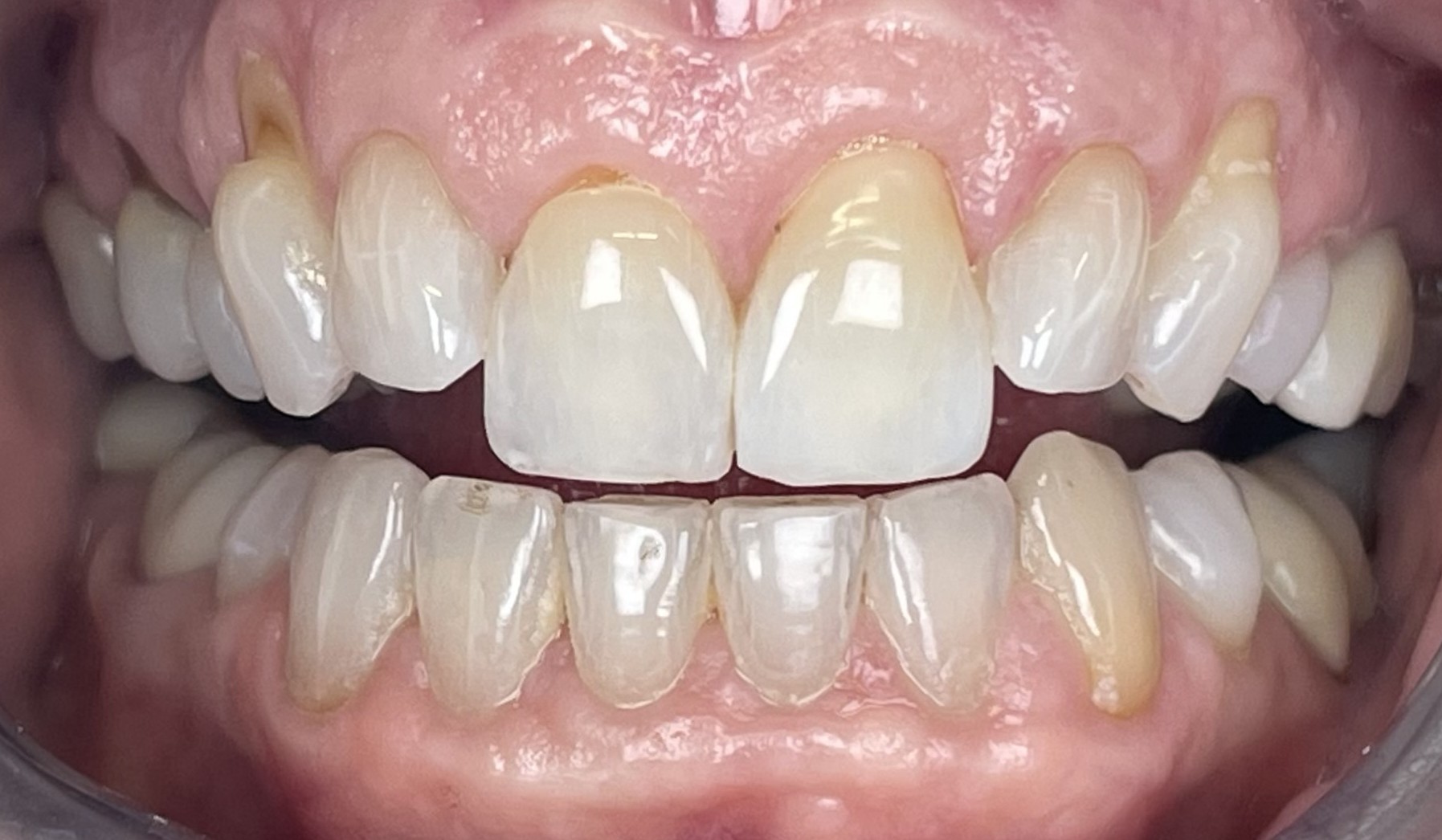 Before Zoom Whitening