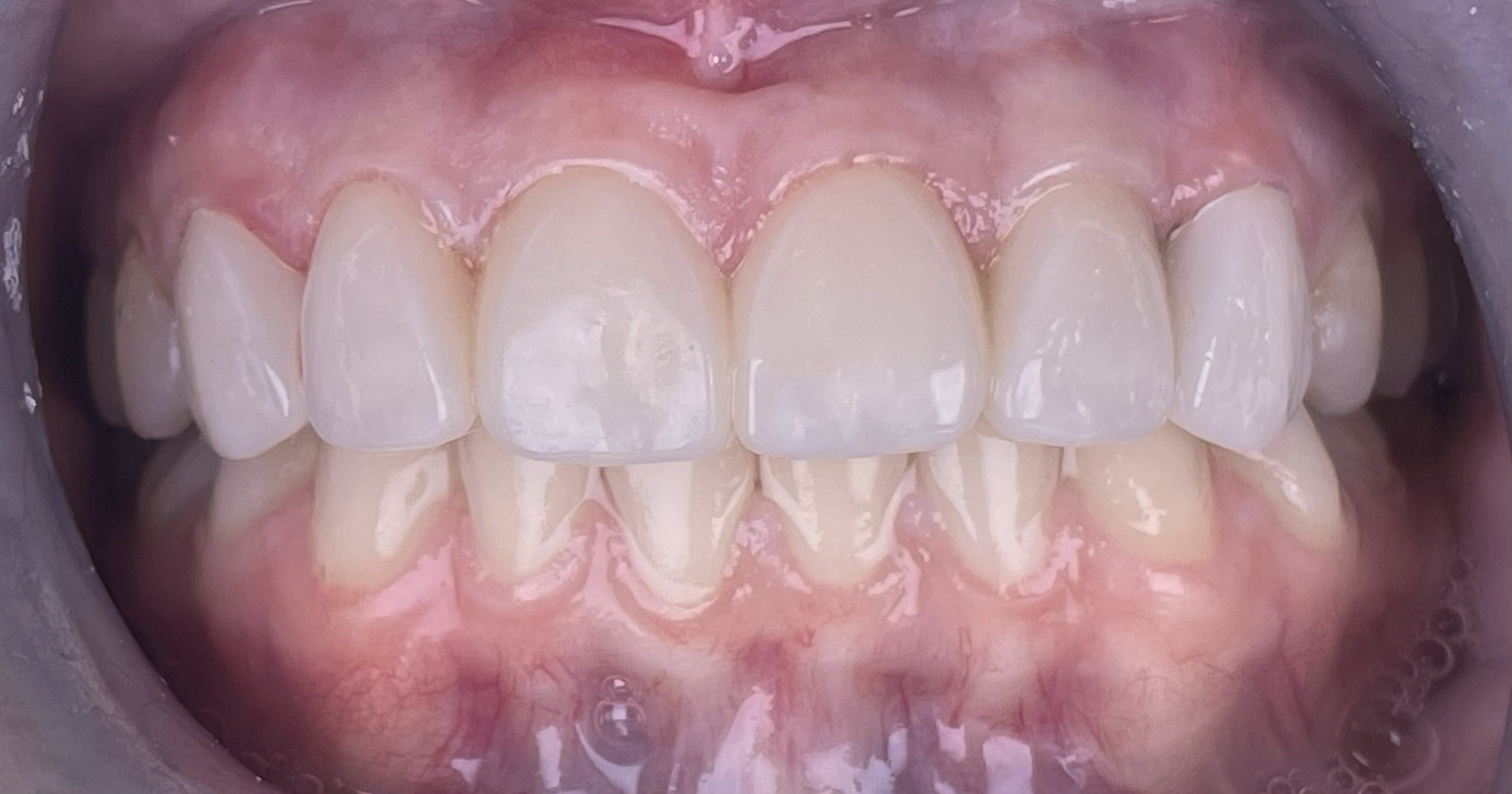 After crowns treatment