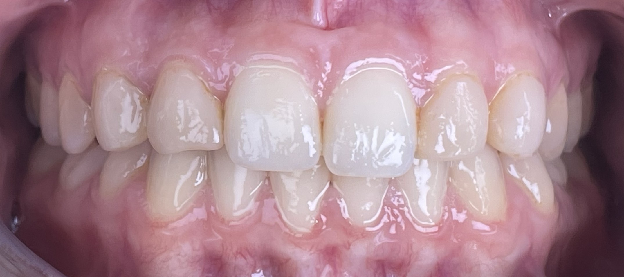 Before crowns treatment