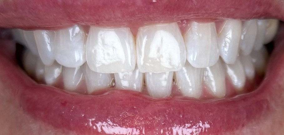 AfterZoom Whitening