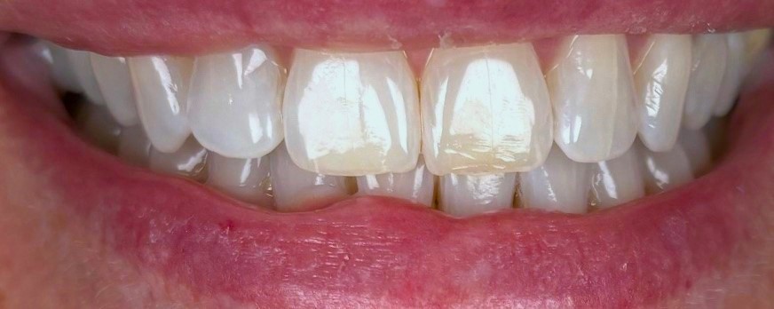 Before Zoom Whitening
