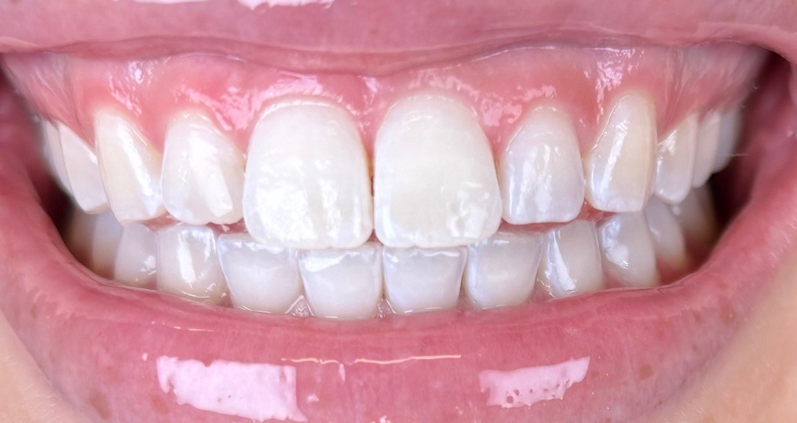 AfterZoom Whitening