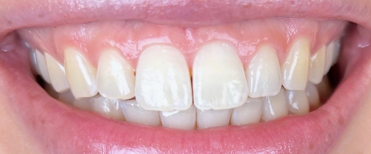 Before Zoom Whitening