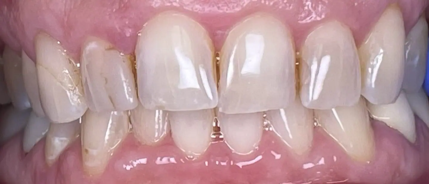 Before crowns treatment