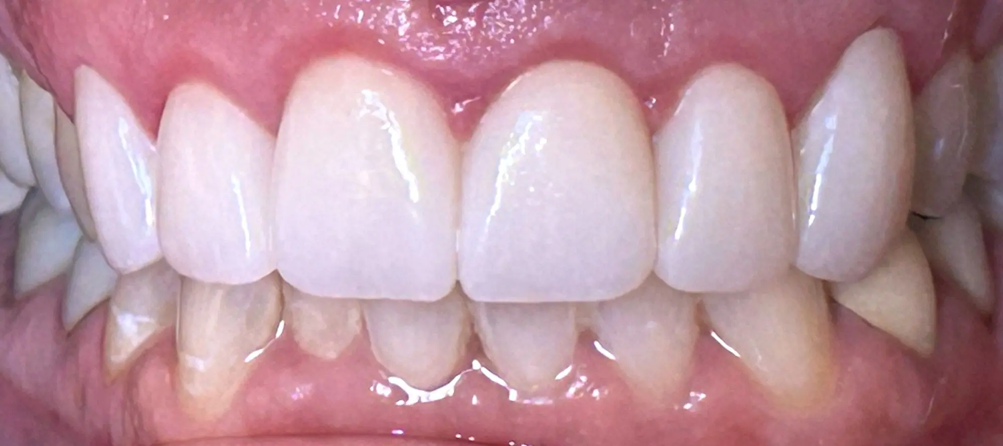 After crowns treatment